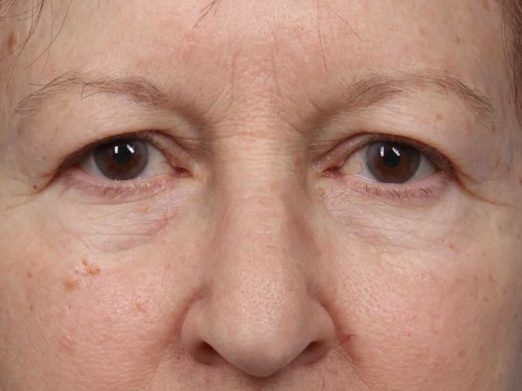Before Image