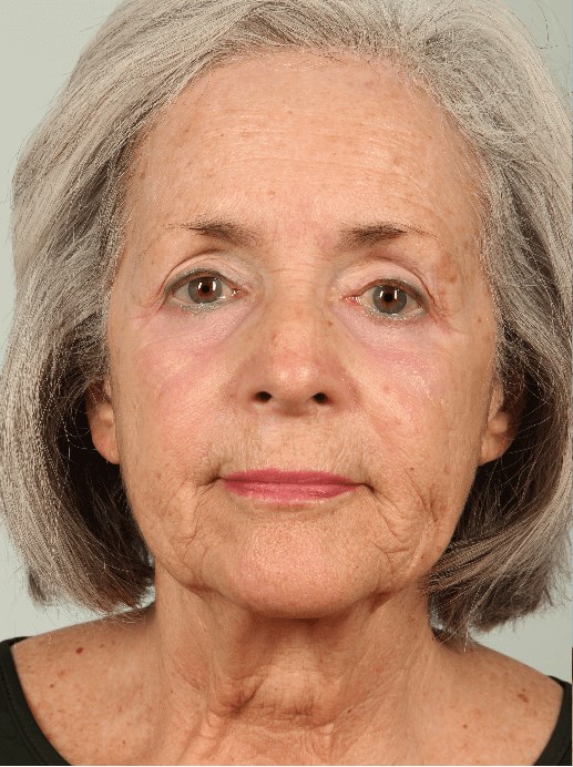 Before Image