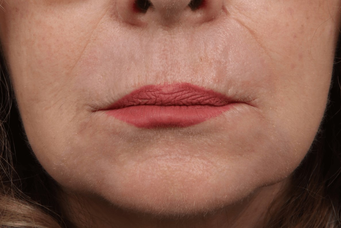 Hetter Peel to Perioral Area