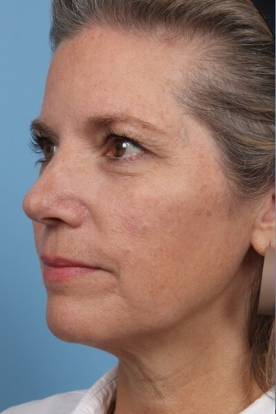 Angle Before