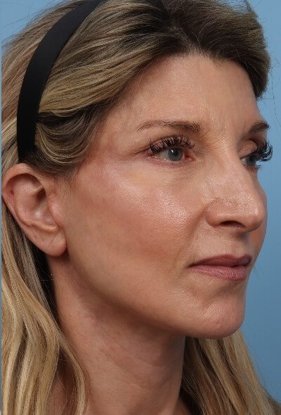 Side View After