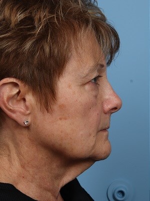 Profile Before