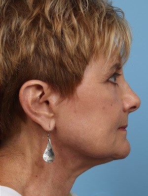 Profile After