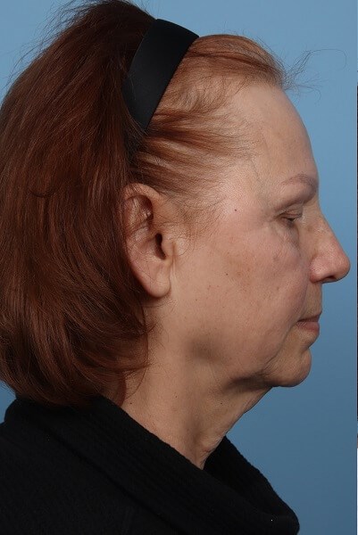 Profile View Before