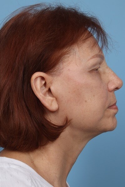 Profile View After
