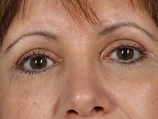 Front View of Brow Lift After