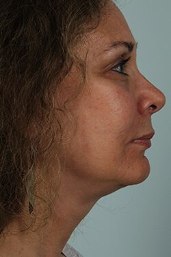 Side View After