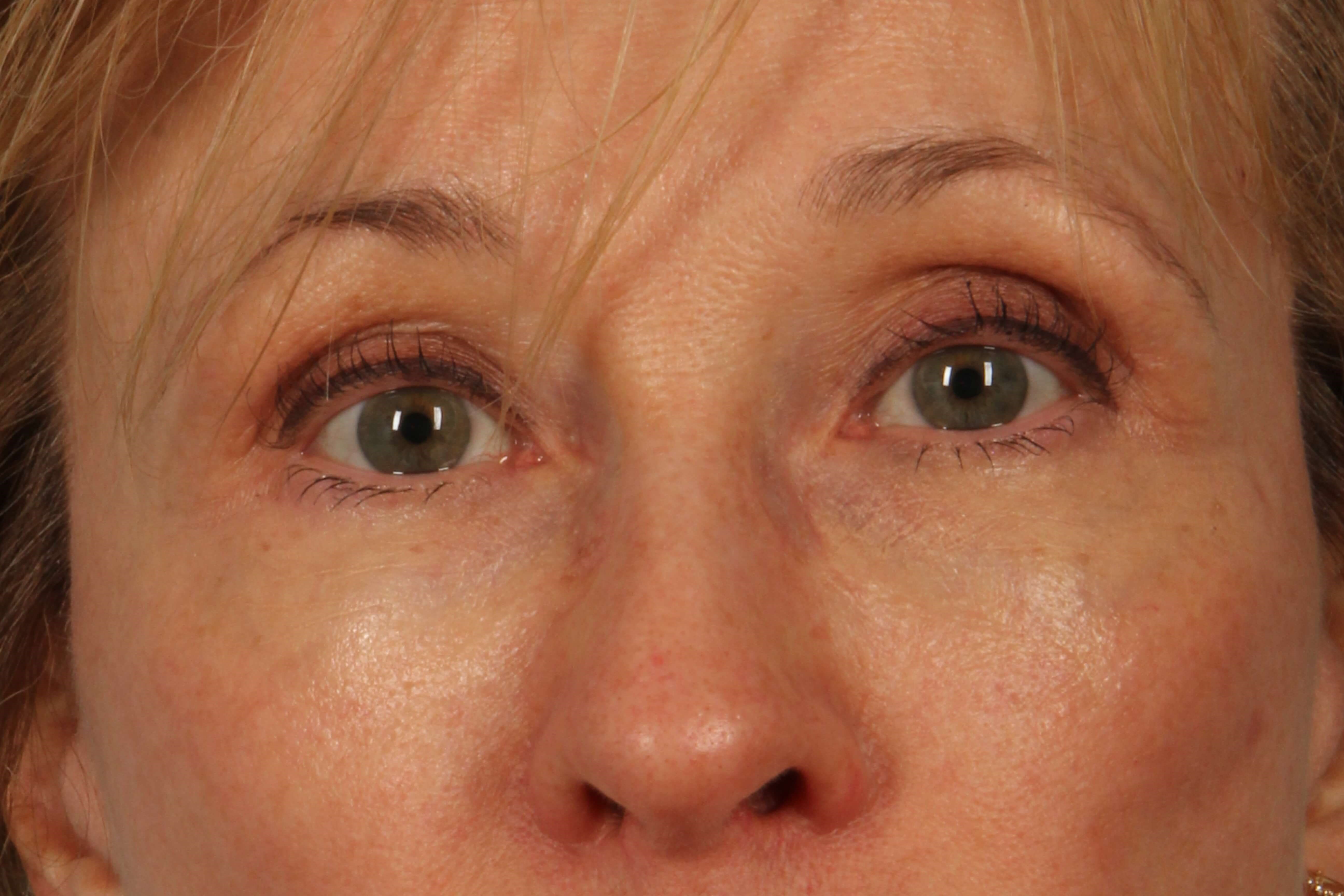 Eyes After
