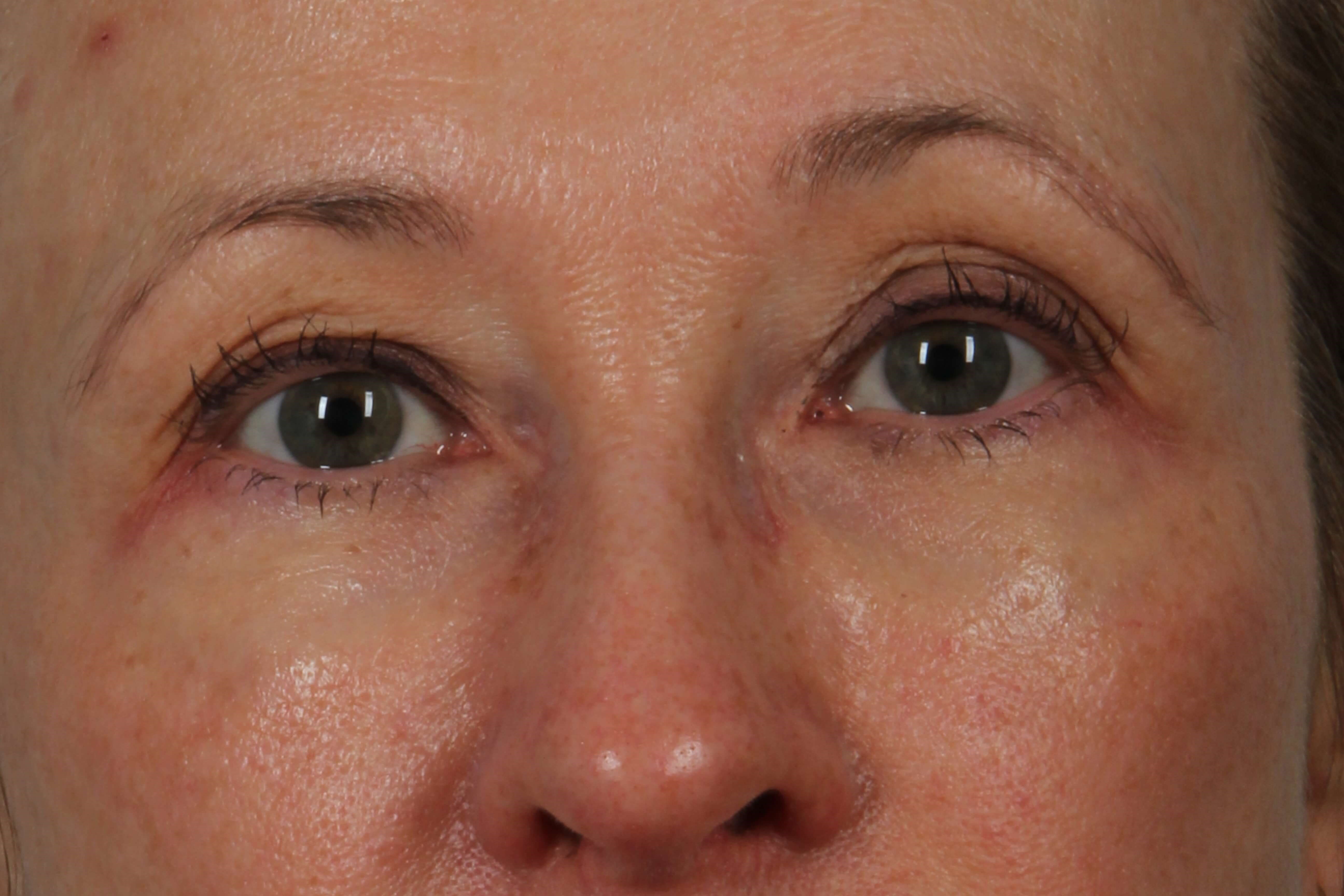 Eyes Before