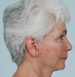 Side View After