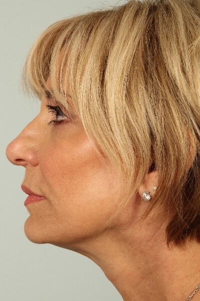 Side View After
