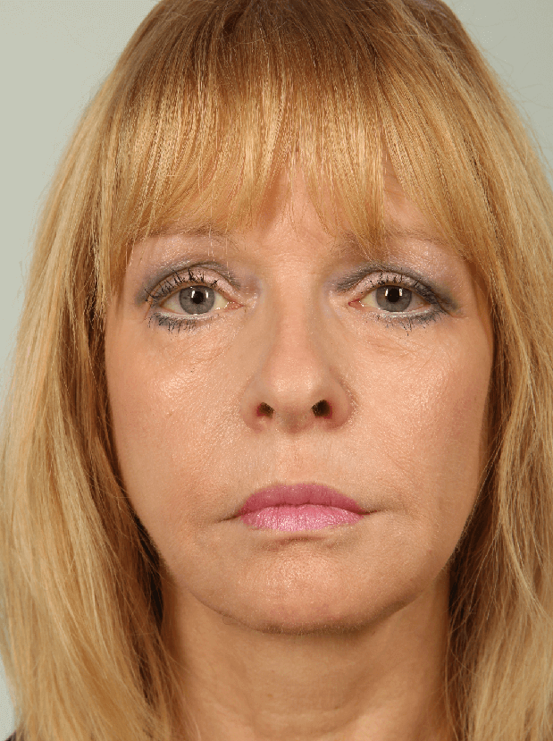 Before Image