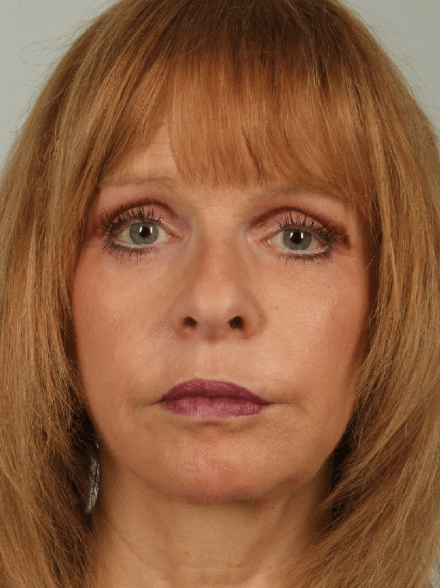 After Image