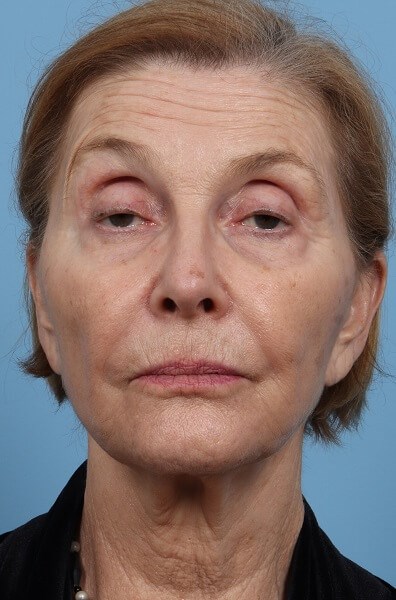 Before Image